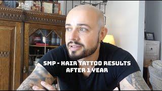 Scalp Micro Pigmentation  (SMP) after 1 year