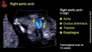 Fetal echocardiography at 11-13 weeks: Right Aortic Arch (RAA)