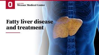 Fatty liver disease and treatment | Ohio State Medical Center