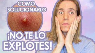 Como tratar EL GRANO - QUE HACER Y QUE NO