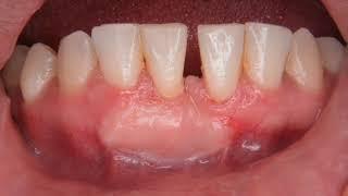 Free gingival graft