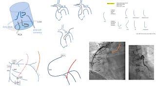 Grafts engagement (femoral+radial): detailed steps, diagrams, troubleshooting, and videos- SVG+LIMA