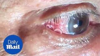 GRAFIS: Saat cacing sepanjang 15cm dikeluarkan dari mata manusia