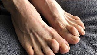 how to get rid of hammer toe without surgery