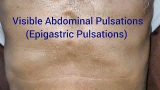 Clinical Examination: Visible Epigastric Pulsations