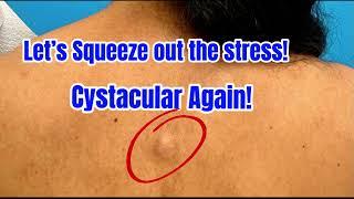 SEBACEOUS CYST REMOVAL BY CHICAGO PLASTIC SURGEON DR MUSSAT