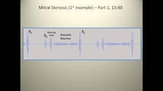 Examples of mitral stenosis murmurs
