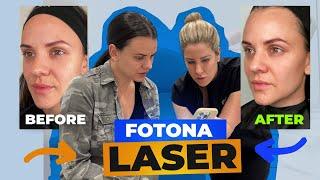 Fotona 4D Laser Before and After - An In Depth Review(2023)