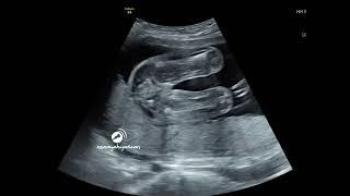 baby girl in 2D ultrasound scan