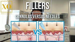 XO Medical Spa // Is cannula or needle for filler injection better?