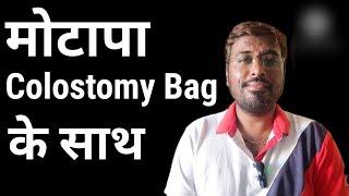 Colostomy bag के साथ क्या वजन बढ़ाना सही है | Weight gain after Ostomy surgery | Jaichand Rajasthani