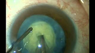 Surgery for a white cataract 6-13-11. Shannon Wong, MD.