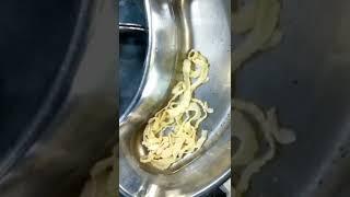 Tapeworm (cestodes) Surgical Removal In A Patient | Informative Video