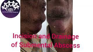 Incision and Drainage of an Abscess | Stepwise Demonstration of I&D | Internship | Surgery