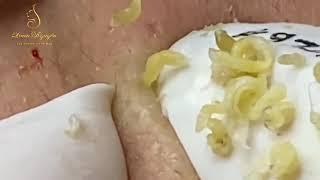 Relax Every Day With Loan Nguyen Spa Video Blackheads Removal HM#012