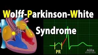 Wolff-Parkinson-White Syndrome Pathophysiology, Pre-Excitation and AVRT, Animation