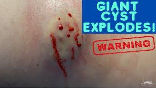 Watch This Giant Cyst SQUIRT! 