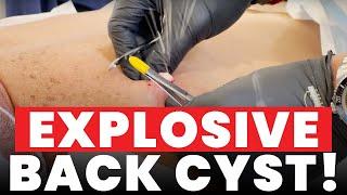 EXPLOSIVE BACK CYST!