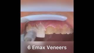 Houston Cosmetic Dentist....How to place Porcelain veneers...What a difference veneers can make!