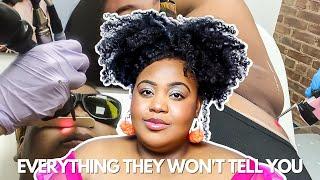 HONEST Truth about Laser Hair Removal on Dark/Black Skin | Very DETAILED Laser Experience + FAQs