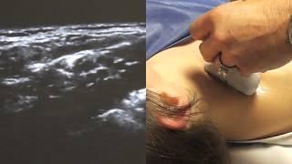 Ultrasound Guided Supraclavicular Nerve Block - SSRAUSA.com