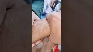 cannulation.. long video.. part 19 #cannula #vigo