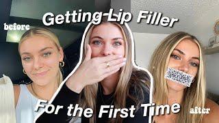 Getting Lip Filler for the First Time + What It Looks Like Months Later