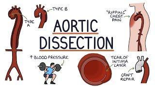 Understanding Aortic Dissection