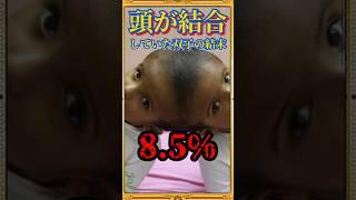 頭部が結合した双子の結末がヤバい。#Shorts #雑学