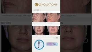 Zinovations #exion By #btlaesthetics #skincare #beauty #emface #fotona4d #fotonalaser #facial