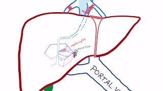 Budd-Chiari syndrome (Pathophysiology)