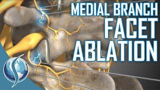 Medial Branch Facet Ablation