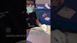 In-Office Otoplasty EAR RESHAPING