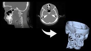 Work In Progress: CT Scan DICOM to 3D Mesh/ STL conversion