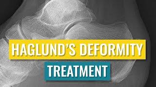 Haglund's Deformity Treatment