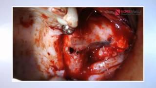 Zygomatic Implant Guided Surgery - Noris Medical