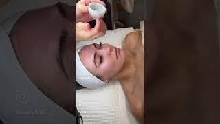 What actually a microneedling treatment looks like !!