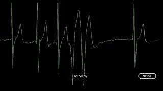 Girl´s irregular heartbeat with ecg 🫀