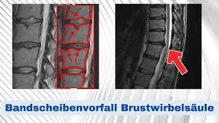 Bandscheibenvorfall Brustwirbelsäule (BWS) - Morbus Scheuermann