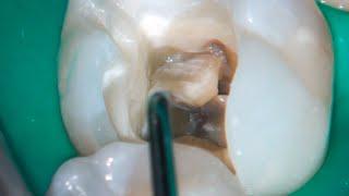 DRendo - Treatment of a necrotic mandibular molar according to the Biologic Endodontic School