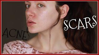 My Acne Scars | December Diary | Melanie Murphy