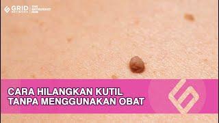 Ampuh! Cara Hilangkan Kutil Dengan Bawang Putih Agar Tak Tumbuh Lagi