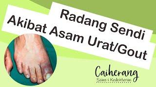 Asam Urat, Hiperurisemia, dan Penyakit Gout - Patofisiologi, Gejala, dan Pengobatannya