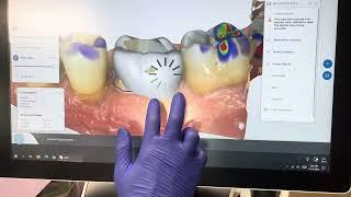 CEREC Zirconia Crown workflow