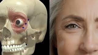 Correct Injection Points for Crow's Feet. Crow's feet Botox Technique.