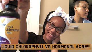 I Tried Drinking Liquid Chlorophyll Water to Cure my Hormonal Cystic Acne! Before and After