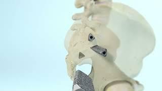 iFuse 3D™ Implant System - Animation