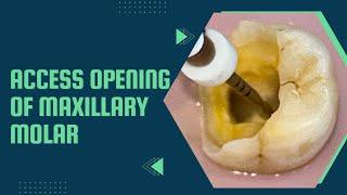 Access opening of decayed lower molar
