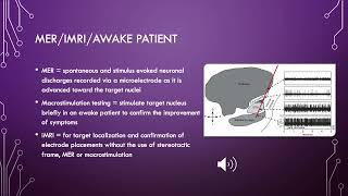 Brain stimulators and the Neuroanesthesist