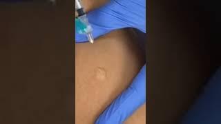 How to Give an Intradermal #Injection  #TBTest #PPD #MedicalAssistant